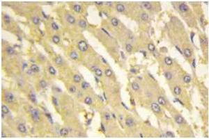 Immunohistochemistry: PFK-2 liv antibody staining of Paraffin-Embedded Human liver carcinoma tissue. (PFKFB1 Antikörper)