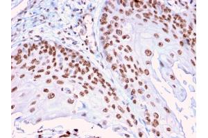 Formalin-fixed, paraffin-embedded human Cervical Carcinoma stained with CLEC9A Mouse Monoclonal Antibody (2H12/4). (DMC1 Antikörper)