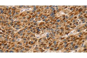 Immunohistochemistry of paraffin-embedded Human liver cancer using TLN1 Polyclonal Antibody at dilution of 1:30 (TLN1 Antikörper)