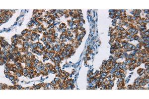 Immunohistochemistry of paraffin-embedded Human breast cancer using HINT2 Polyclonal Antibody at dilution of 1:50 (HINT2 Antikörper)