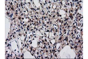 Immunohistochemical staining of paraffin-embedded Carcinoma of Human kidney tissue using anti-BIN3 mouse monoclonal antibody. (BIN3 Antikörper)