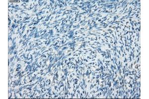 Immunohistochemical staining of paraffin-embedded Adenocarcinoma of breast tissue using anti-PRKAR1A mouse monoclonal antibody.