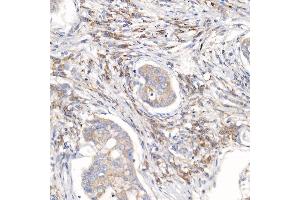 Immunohistochemistry of paraffin-embedded human lung cancer using RPL26L1 antibody (ABIN7270000) at dilution of 1:50 (40x lens). (RPL26L1 Antikörper)