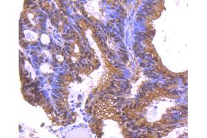Paraformaldehyde-fixed, paraffin embedded human colon cancer, Antigen retrieval by boiling in sodium citrate buffer (pH6. (YWHAE Antikörper)