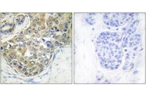Immunohistochemistry analysis of paraffin-embedded human breast carcinoma, using ACK1 (Phospho-Tyr284) Antibody. (TNK2 Antikörper  (pTyr284))