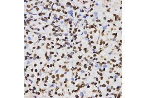Immunohistochemistry of paraffin-embedded human kidney cancer using DiMethyl-Histone H3-K4 antibody (ABIN1872995) at dilution of 1:200 (40x lens). (Histone 3 Antikörper  (H3K4me2))