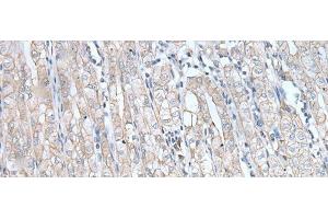 Immunohistochemistry of paraffin-embedded Human gastric cancer tissue using SPTA1 Polyclonal Antibody at dilution of 1:80(x200) (SPTA1 Antikörper)