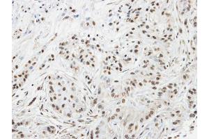 IHC-P Image Immunohistochemical analysis of paraffin-embedded A549 xenograft, using SPHK1, antibody at 1:100 dilution.