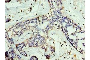 Immunohistochemistry of paraffin-embedded human breast cancer using ABIN7153848 at dilution of 1:100 (GAN Antikörper  (AA 1-240))