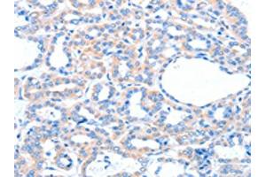 The image on the left is immunohistochemistry of paraffin-embedded Human thyroid cancer tissue using ABIN7128170(ACOX1 Antibody) at dilution 1/20, on the right is treated with fusion protein. (ACOX1 Antikörper)