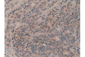 IHC-P analysis of Human Prostate Gland Cancer Tissue, with DAB staining. (MTOR Antikörper  (AA 2226-2488))