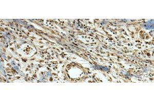 Immunohistochemistry of paraffin-embedded Human breast cancer tissue using MLF1 Polyclonal Antibody at dilution of 1:105(x200) (MLF1 Antikörper)
