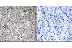Immunohistochemistry analysis of paraffin-embedded human lung carcinoma tissue, using ARHGEF9 Antibody. (Arhgef9 Antikörper  (AA 399-448))