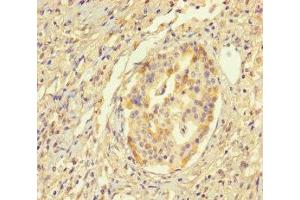 Immunohistochemistry of paraffin-embedded human pancreatic cancer using ABIN7155943 at dilution of 1:100 (Chromosome X Open Reading Frame 27 (CXORF27) (AA 1-117) Antikörper)
