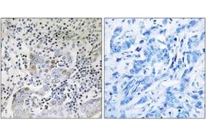Immunohistochemistry analysis of paraffin-embedded human breast carcinoma tissue, using SESN1 Antibody.