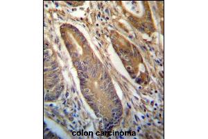 NETO2 Antibody (N-term ) (ABIN657245 and ABIN2846343) immunohistochemistry analysis in formalin fixed and paraffin embedded human colon carcinoma followed by peroxidase conjugation of the secondary antibody and DAB staining. (NETO2 Antikörper  (N-Term))