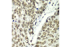 Immunohistochemistry of paraffin-embedded human esophageal cancer using TEAD1 antibody (ABIN6291475) at dilution of 1:100 (40x lens). (TEAD1 Antikörper)
