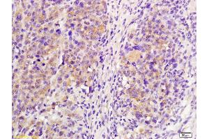 Formalin-fixed and paraffin embedded mouse lymphoma labeled with Anti-IL-21R Polyclonal Antibody, Unconjugated (ABIN748148) at 1:200 followed by conjugation to the secondary antibody and DAB staining