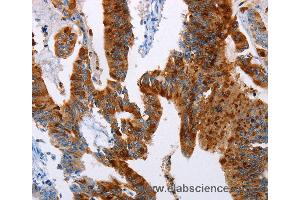 Immunohistochemistry of Human colon cancer using TFF3 Polyclonal Antibody at dilution of 1:50 (TFF3 Antikörper)