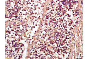 Formalin-fixed and paraffin embedded human lung carcinoma labeled with Anti-Phospho-RSK2 (Ser227) Polyclonal Antibody, Unconjugated (ABIN745268) at 1:200 followed by conjugation to the secondary antibody and DAB staining (RPS6KA3 Antikörper  (pSer227))