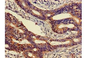 Immunohistochemistry of paraffin-embedded human colon cancer using ABIN7146807 at dilution of 1:100 (CEACAM7 Antikörper  (AA 36-242))
