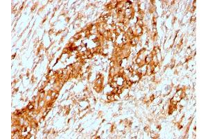 Formalin-fixed, paraffin-embedded human Breast stained with Alpha-1-Antitrypsin Recombinant Rabbit Monoclonal Antibody (AAT/3167R).