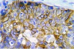 Immunohistochemistry (IHC) analyzes of p-Crk2 antibody in paraffin-embedded human lung adenocarcinoma tissue. (Crk Antikörper  (pTyr221))