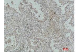Immunohistochemical analysis of paraffin-embedded Human Lung Carcinoma using MICU1 Monoclonal Antibody.