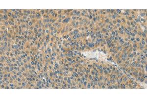 Immunohistochemistry of paraffin-embedded Human liver cancer using ASPA Polyclonal Antibody at dilution of 1:80 (ASPA Antikörper)