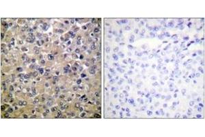 Immunohistochemistry analysis of paraffin-embedded human breast carcinoma tissue, using PP1-alpha (Ab-320) Antibody.