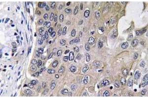 Immunohistochemistry analysis of GCS-alpha-1 antibody in paraffin-embedded human lung carcinoma tissue. (GUCY1A1 Antikörper)