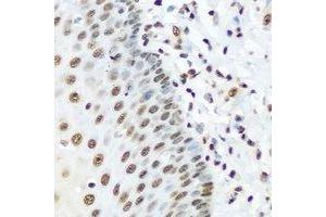 Immunohistochemical analysis of hnRNP R staining in human esophageal cancer formalin fixed paraffin embedded tissue section. (HNRNPR Antikörper)