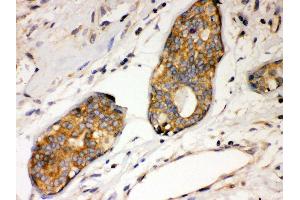 Anti- IKB alpha Picoband antibody, IHC(P) IHC(P): Human Mammary Cancer Tissue (NFKBIA Antikörper  (AA 3-112))