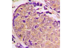 Immunohistochemical analysis of Alpha-synuclein (pS129) staining in human prostate cancer formalin fixed paraffin embedded tissue section. (SNCA Antikörper  (C-Term, pSer129))