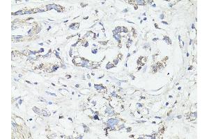 Immunohistochemistry of paraffin-embedded human gastric cancer using MAP1LC3B antibody (ABIN6291774) at dilution of 1:100 (40x lens). (LC3B Antikörper)