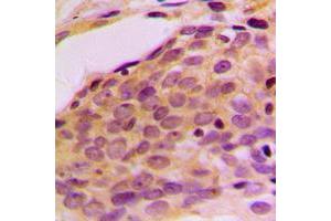 Immunohistochemical analysis of p116 Rip staining in human breast cancer formalin fixed paraffin embedded tissue section. (MPRIP Antikörper  (Center))