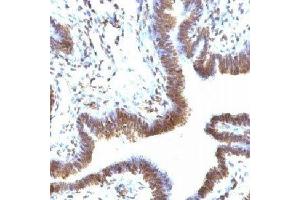 IHC testing of FFPE human ovarian carcinoma and EMI-1 antibody (FBXP5). (FBXO5 Antikörper  (N-Term))