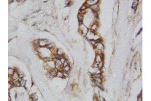 Anti-CDC42 antibody, IHC(P) IHC(P): Human Mammary Cancer Tissue (CDC42 Antikörper  (Middle Region))
