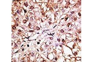 IHC analysis of FFPE human hepatocarcinoma tissue stained with the BNIP3L antibody (BNIP3L/NIX Antikörper  (AA 122-152))