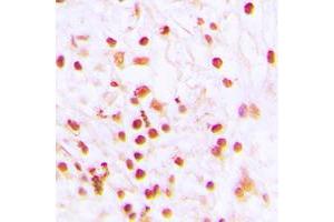 Immunohistochemical analysis of ERCC6 staining in human lung cancer formalin fixed paraffin embedded tissue section. (ERCC6 Antikörper  (N-Term))