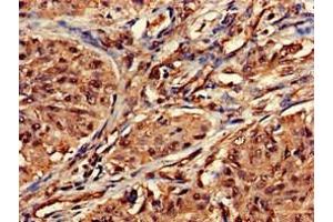 Immunohistochemistry of paraffin-embedded human lung cancer using ABIN7155530 at dilution of 1:100 (DOT1L Antikörper  (AA 331-484))
