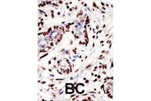 Formalin-fixed and paraffin-embedded human cancer tissue reacted with the MLL polyclonal antibody  , which was peroxidase-conjugated to the secondary antibody, followed by AEC staining. (MLL/KMT2A Antikörper  (AA 312-343))