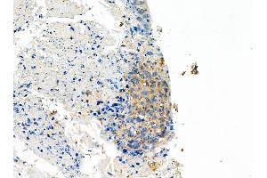 ABIN6258856 and ABIN6275099 at 1/100 staining Human pancreatic cancer by IHC-P.
