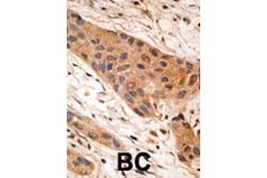 Formalin-fixed and paraffin-embedded human cancer tissue reacted with the primary antibody, which was peroxidase-conjugated to the secondary antibody, followed by AEC staining. (BNIP1 Antikörper  (AA 92-127))