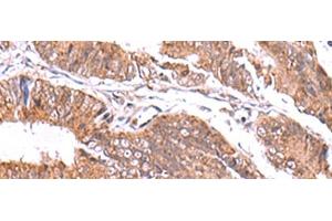 Immunohistochemistry of paraffin-embedded Human colorectal cancer tissue using GATM Polyclonal Antibody at dilution of 1:70(x200)