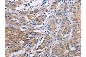 The image on the left is immunohistochemistry of paraffin-embedded Human lung cancer tissue using ABIN7128287(AGBL5 Antibody) at dilution 1/30, on the right is treated with fusion protein. (AGBL5 Antikörper)