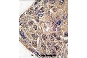 Formalin-fixed and paraffin-embedded human lung carcinoma tissue reacted with YARS antibody (C-term) (ABIN391839 and ABIN2841678) , which was peroxidase-conjugated to the secondary antibody, followed by DAB staining.