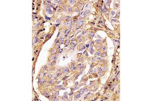 (ABIN659120 and ABIN2843760) staining CD44 in human lung adenocarcinoma tissue sections by Immunohistochemistry (IHC-P - paraformaldehyde-fixed, paraffin-embedded sections). (CD44 Antikörper)