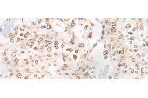 Immunohistochemistry of paraffin-embedded Human prost ate cancer tissue using CEP72 Polyclonal Antibody at dilution of 1:40(x200) (CEP72 Antikörper)