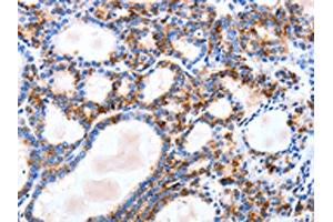 The image on the left is immunohistochemistry of paraffin-embedded Human thyroid cancer tissue using ABIN7129823(IGSF6 Antibody) at dilution 1/10, on the right is treated with fusion protein. (IGSF6 Antikörper)
